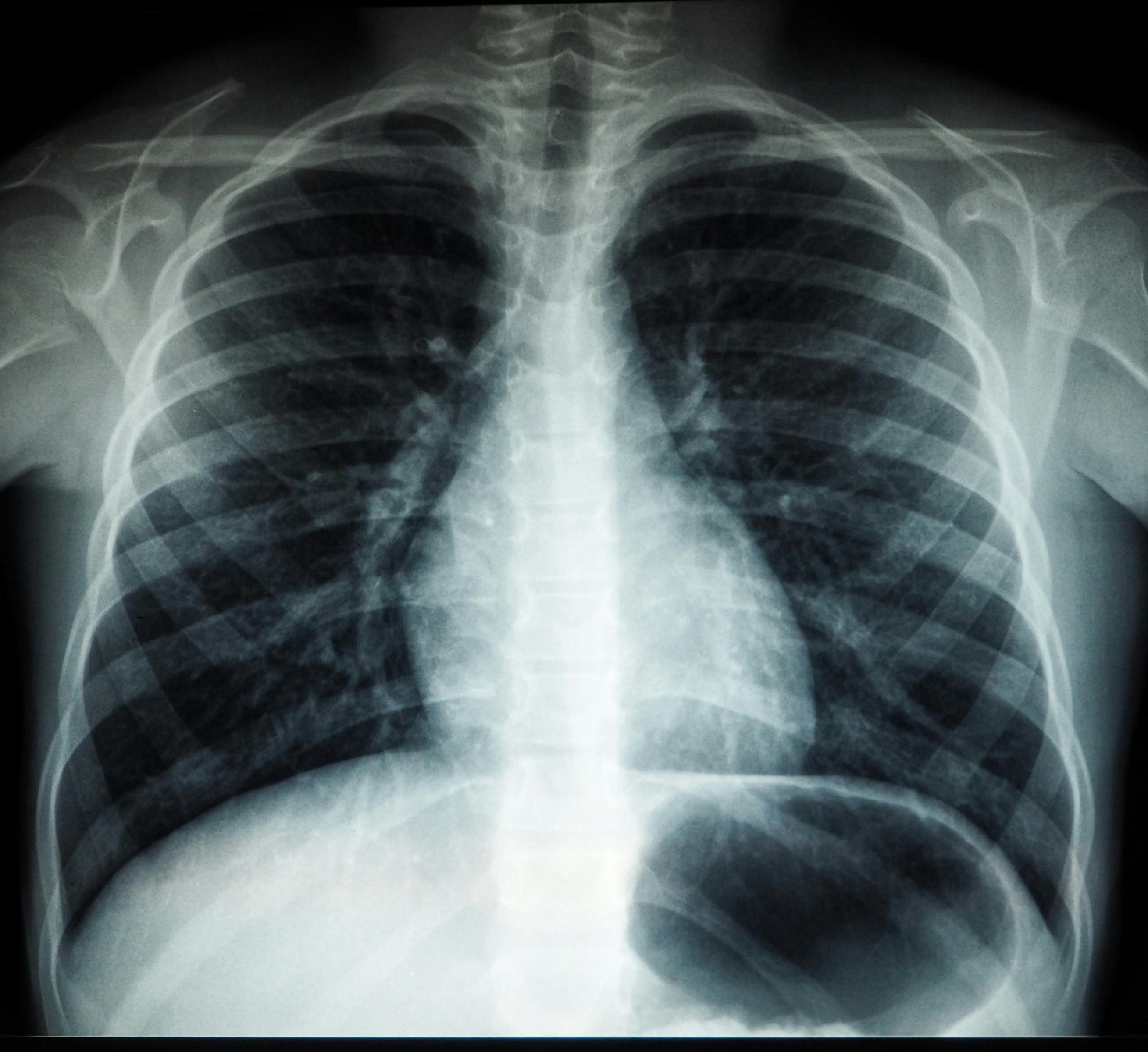 xray image of lungs