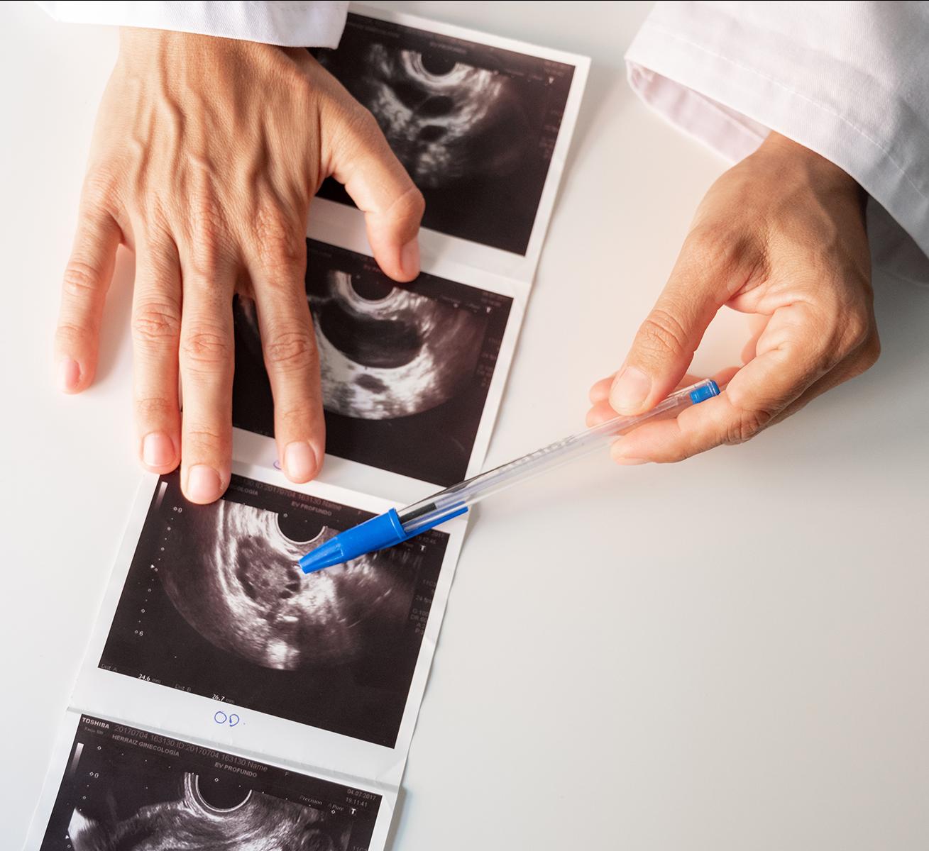 Doctor discussing polycystic ovary syndrome on ultrasound scans