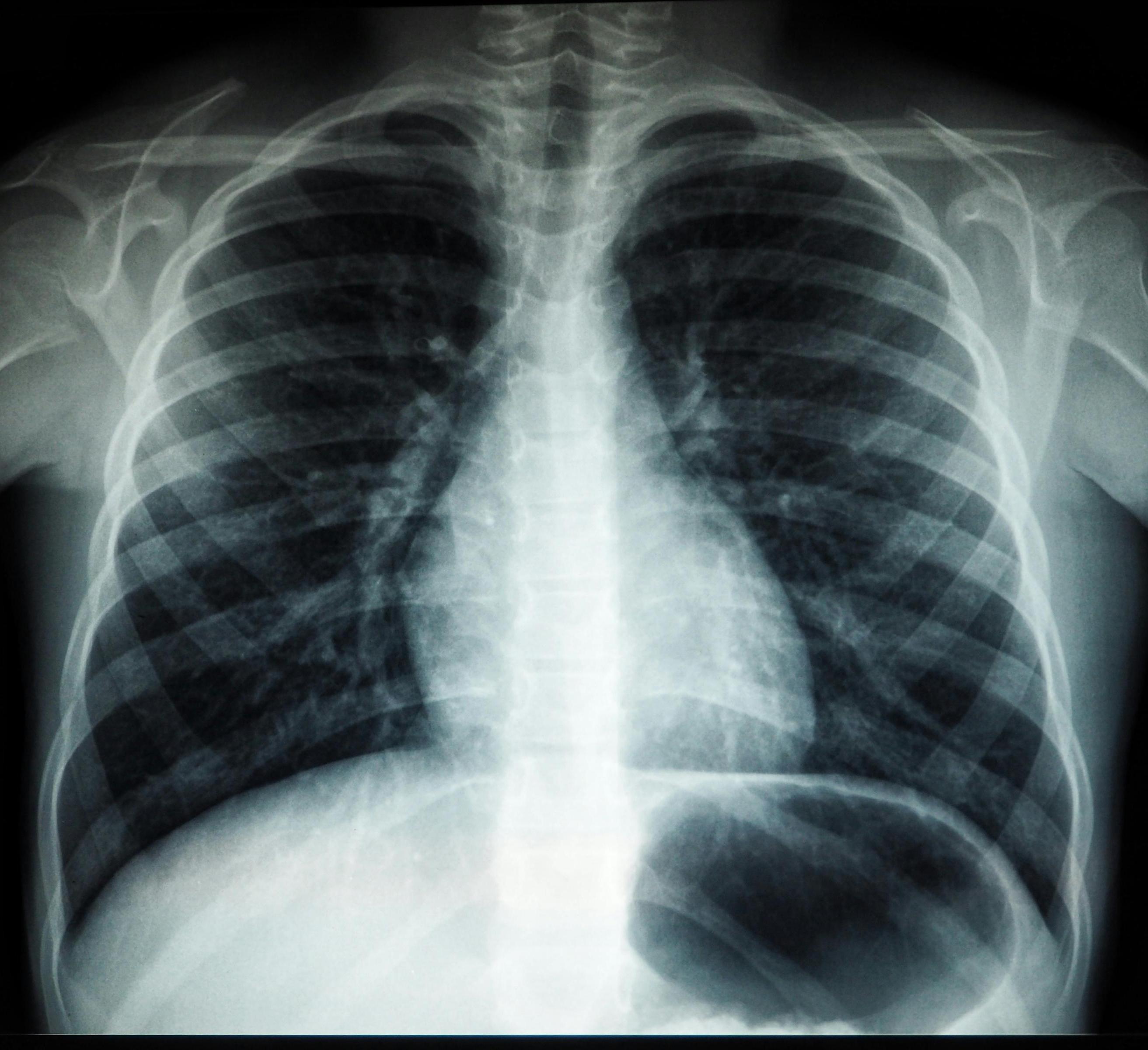 xray image of lungs