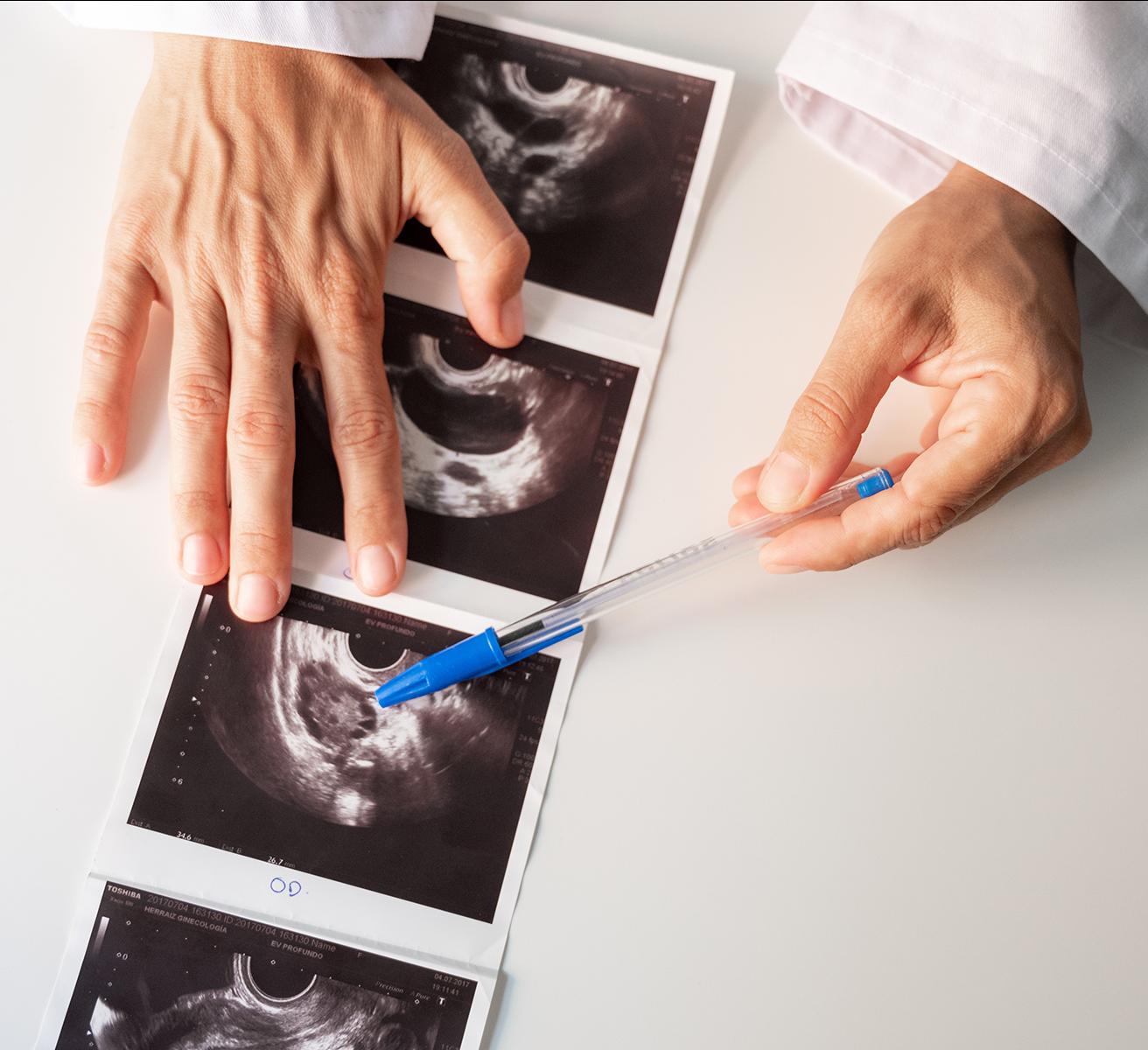 Doctor discussing polycystic ovary syndrome on ultrasound scans